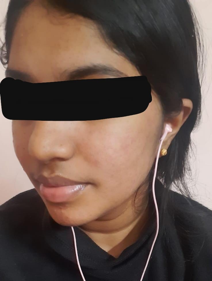 Acne Vulgaris 8